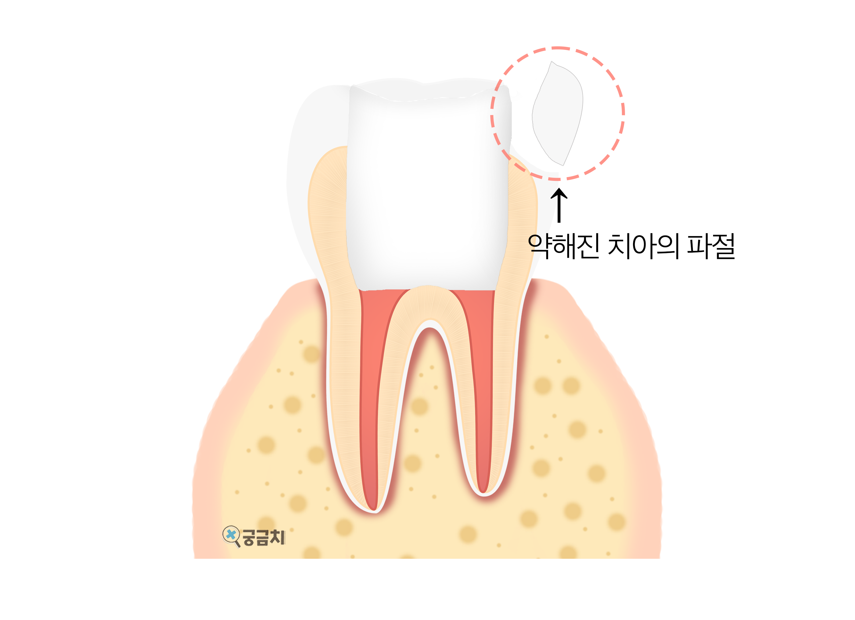 크라운 필요성 - 신경치료 후 치아파절